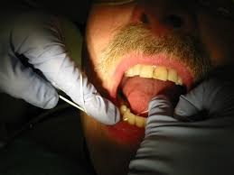exemple d'application du fil dentaire
